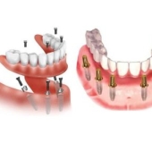 TRỒNG RĂNG IMPLANT NGUYÊN HÀM ALL ON 4, ALL ON 6