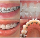 Cách chọn mắc cài niềng răng phù hợp?