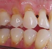 MÒN CỔ CHÂN RĂNG LÀ GÌ? CÓ NGUY HIỂM KHÔNG?
