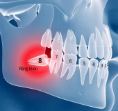 CÓ NÊN NHỔ RĂNG KHÔN NẰM NGANG?